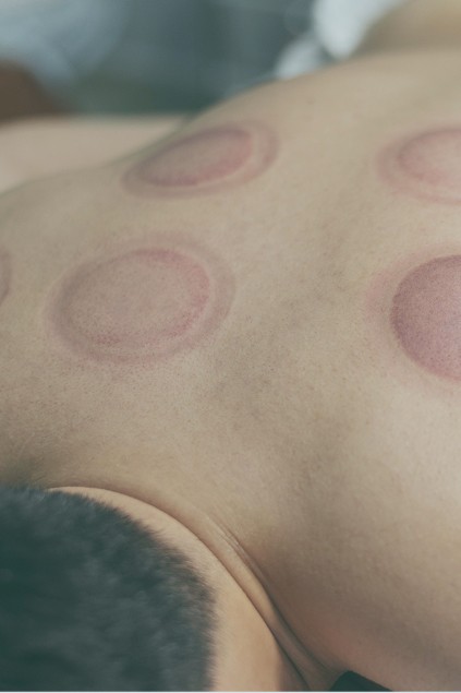 cupping marks
