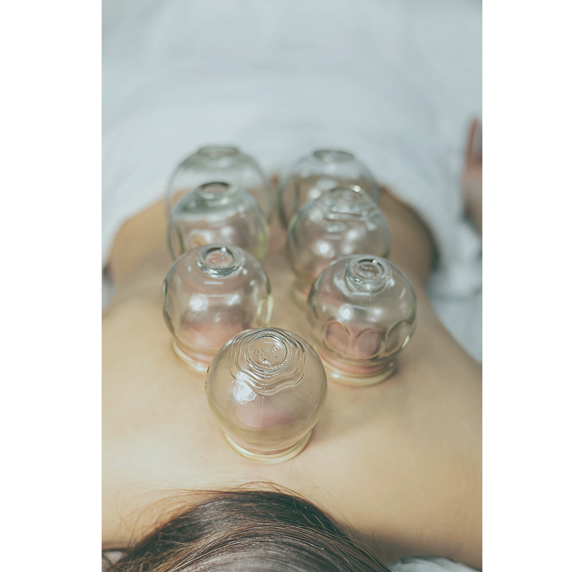 Cupping therapy